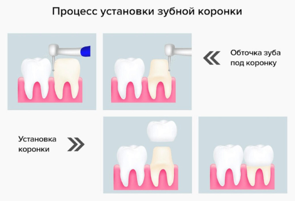 Минута отдыха Установка зубных коронок: когда это необходимо? Полезности  