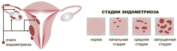 Минута отдыха Больше чем боль: комплексный взгляд на эндометриоз брюшной полости Полезности  