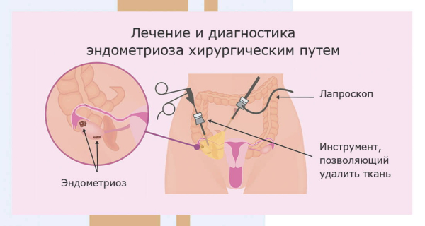 Минута отдыха Больше чем боль: комплексный взгляд на эндометриоз брюшной полости Полезности  