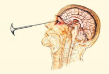 Минута отдыха Как появилась лоботомия и почему её запретили? Интересное 
