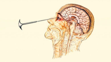 Минута отдыха Как появилась лоботомия и почему её запретили? Интересное 