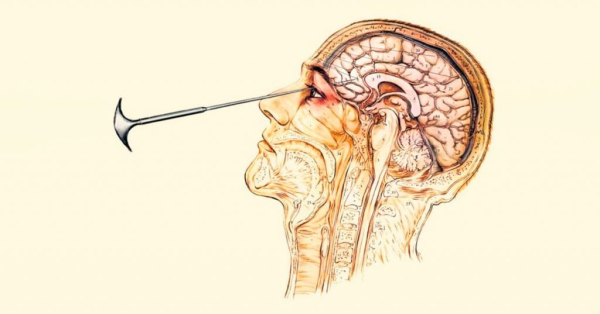 Минута отдыха Как появилась лоботомия и почему её запретили? Интересное Минута отдыха Как появилась лоботомия и почему её запретили? Интересное