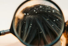 Минута отдыха Виды перхоти на голове: как отличить сухую от опасной (и чем лечить прямо сейчас) Интересное 